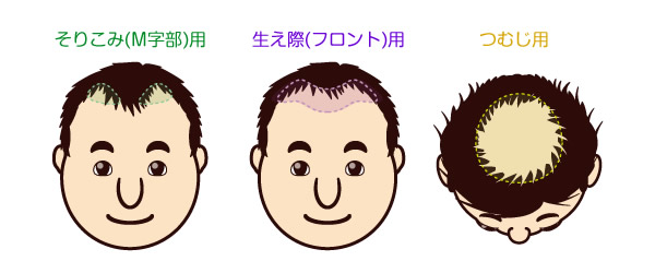 そりこみ用、生え際用、つむじ用の部分かつらの範囲