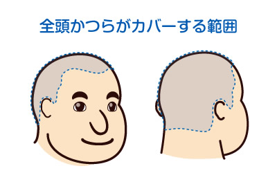 全頭かつら（フルウィッグ）がカバーする範囲