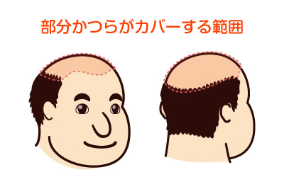 一般的な部分かつら（男性用）がカバーする範囲