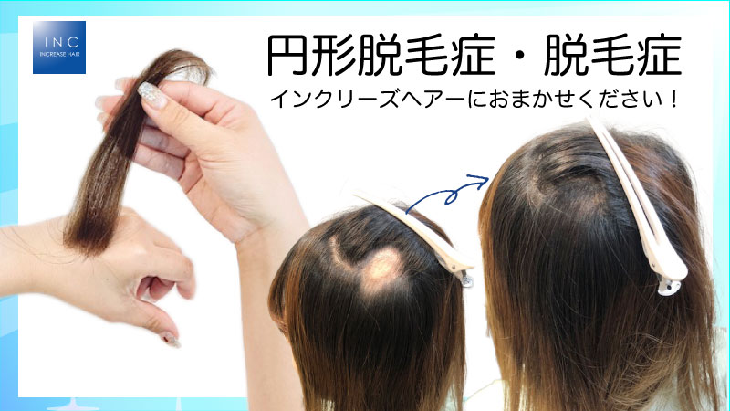 円形脱毛症もインクリーズヘアーにおまかせください