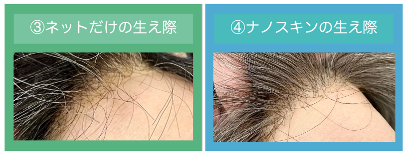 ③ネットだけのかつらの生え際の写真(切りっぱなしネット)
④ナノスキン(極薄人工皮膚)のかつらの生え際の写真