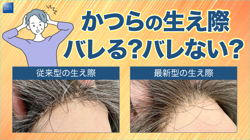 かつらの生え際、バレる？バレない？