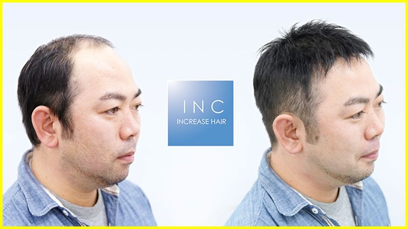 通気性と通水性に優れた極薄かつらのビフォーアフター