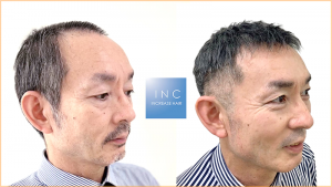 極薄かつらのビフォーアフター