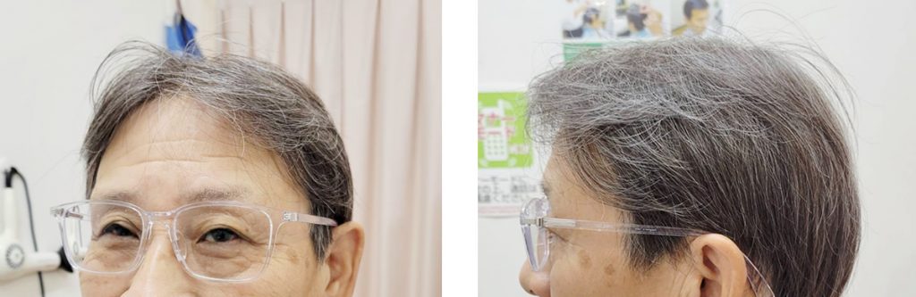 少ない毛量、白髪入りでも自然に仕上がるMFFの写真