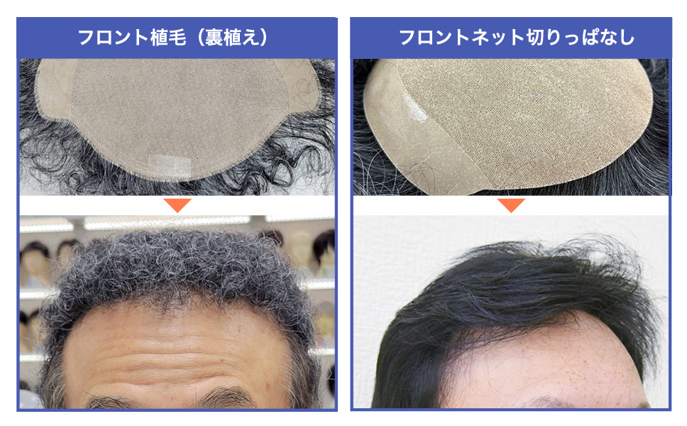 MFFの生え際（フロント植毛・フロント切りっぱなし）