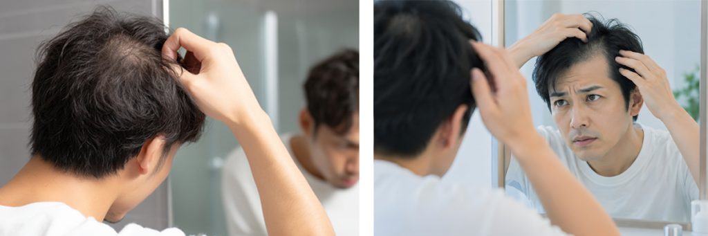 AGAに悩む男性の写真