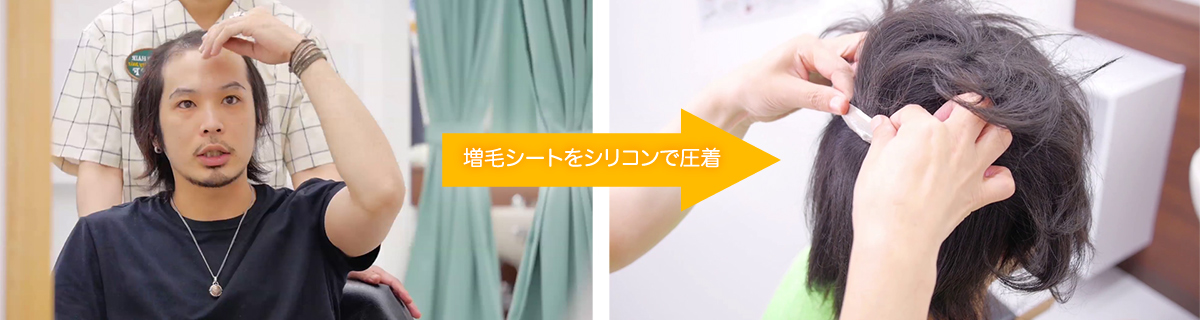 即日増毛ヘアーインプラントONEの施術風景