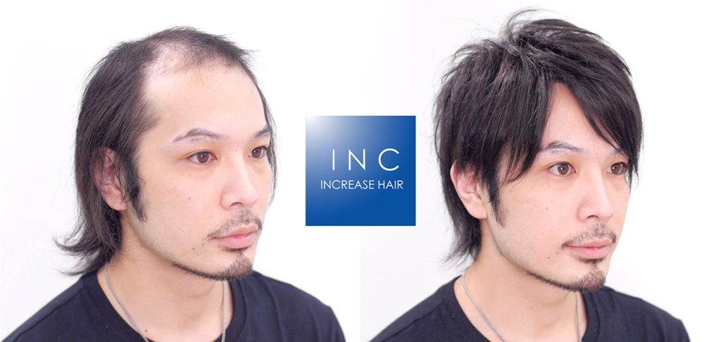 即日増毛ヘアーインプラントONEの施術前後の写真