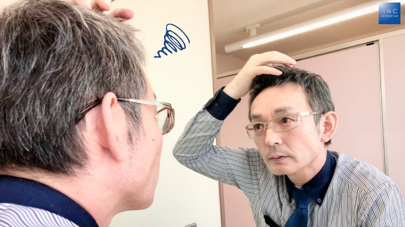 「AGA治療」実際どうなの!?薄毛に悩む男性